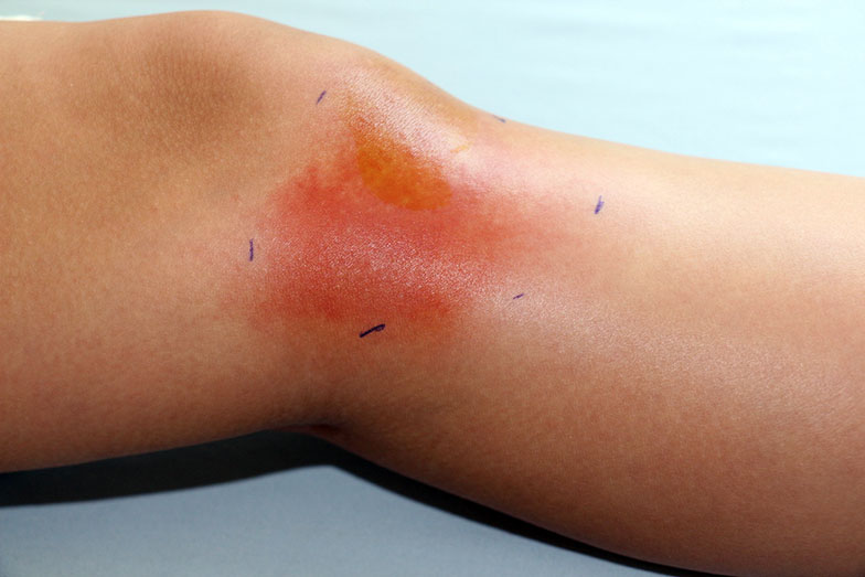 Inflamação