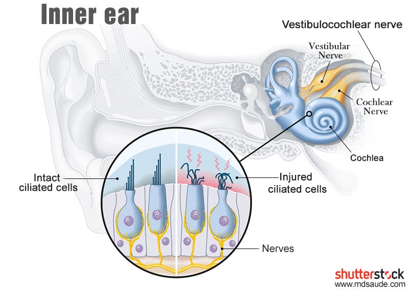 Inner ear - Damage to the hair cells of the cochlea