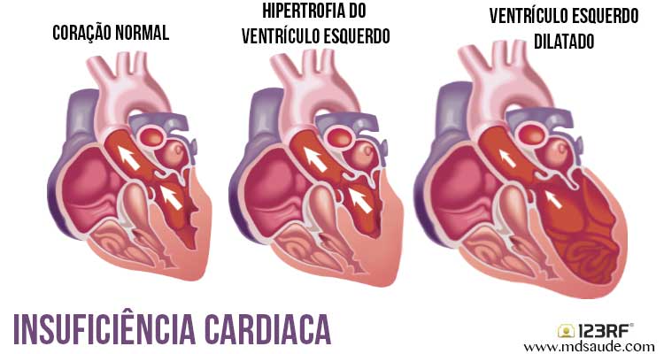 Insuficiência cardíaca