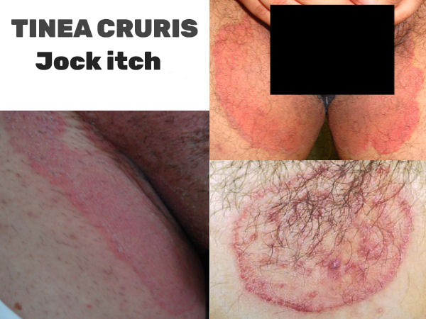 Tinea cruris