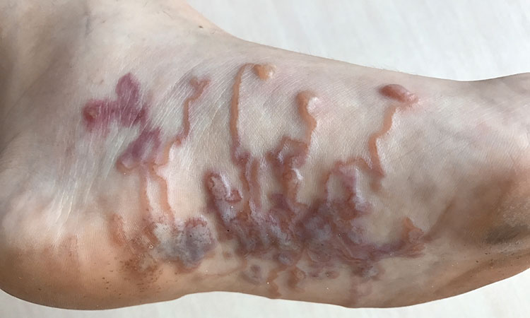 Larva migrans no pé com múltiplos pontos de entrada