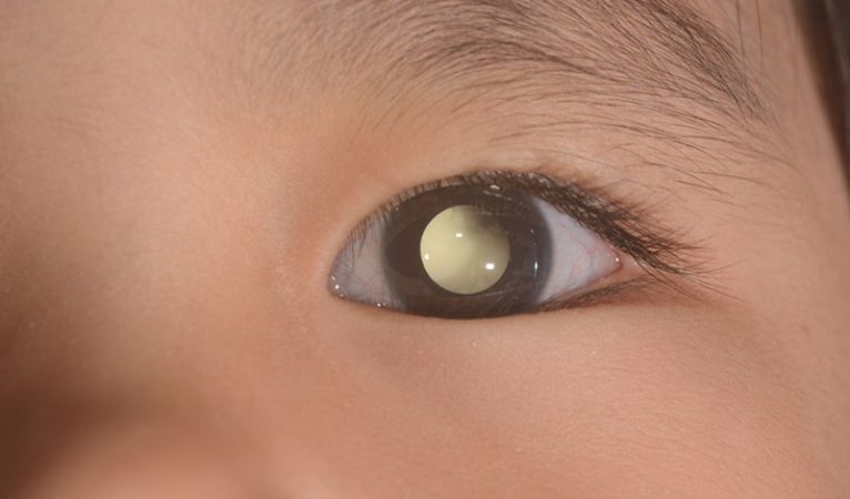 Leucocoria
