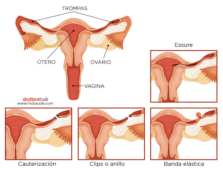 Ligadura de trompas – técnicas más comunes.
