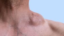Linfoma