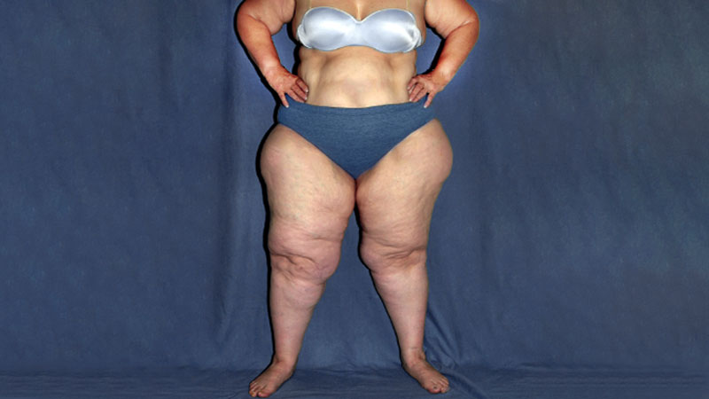 Lipedema