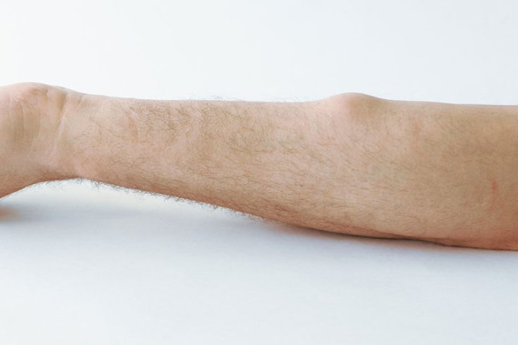 Lipoma no antebraço