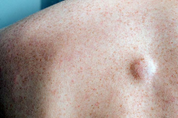 Lipoma en la espalda