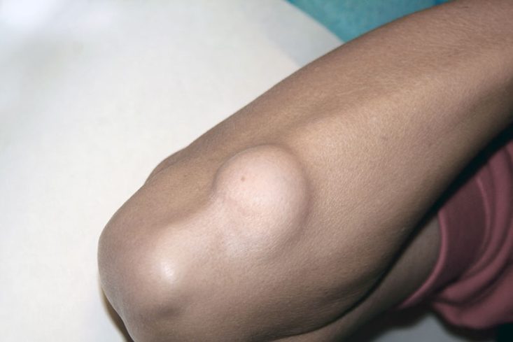 Lipoma no cotovelo