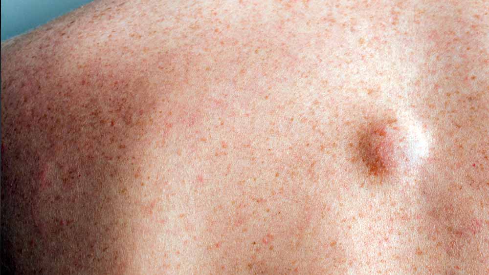 Fotos de lipoma (no braço, costas, pescoço e cirurgia)