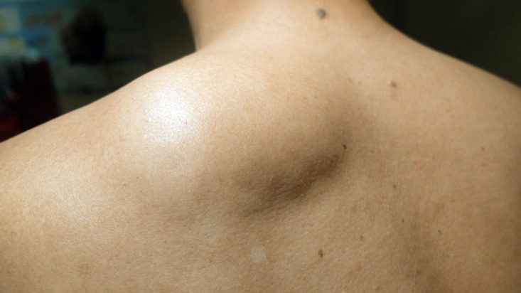Lipoma grande nas costas