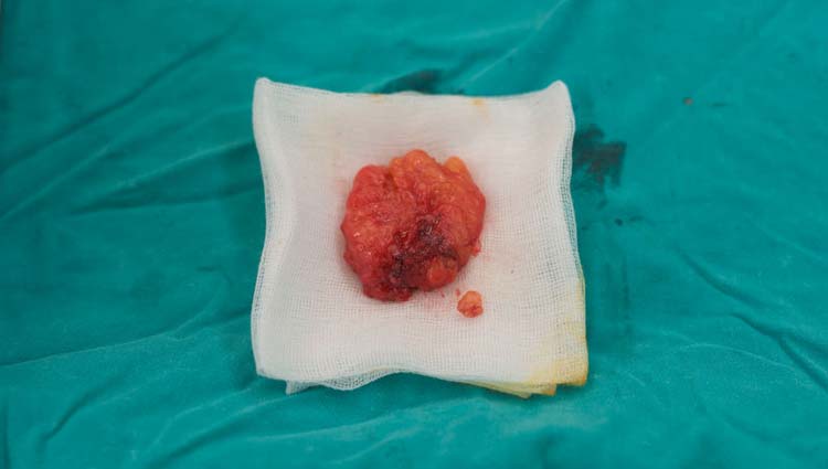 Lipoma extirpado quirúrgicamente