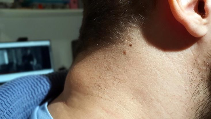 Lipoma no pescoço