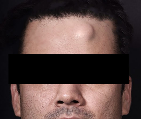 Lipoma na testa