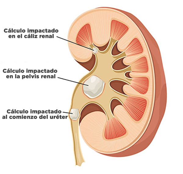 Diferentes puntos de impactación del cálculo renal