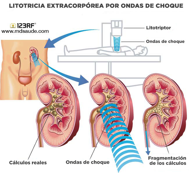 Litotricia extracorpórea por ondas de choque