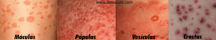Tipos de rash cutâneo: mácula, pápula, vesícula e crostas