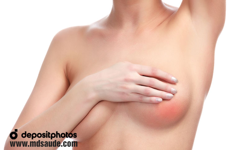 Mastitis en la mama izquierda