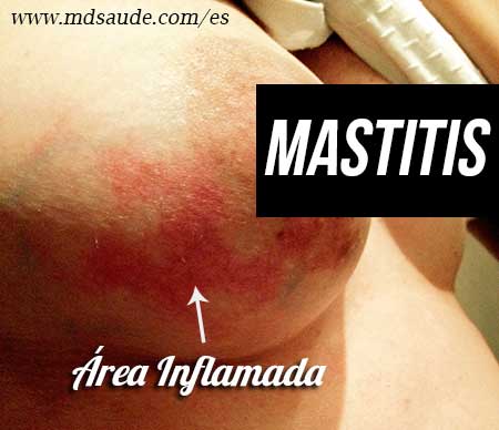 Mastitis