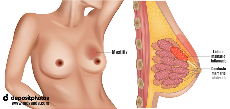 Cómo se produce la mastitis