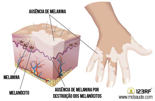 Como surge o vitiligo