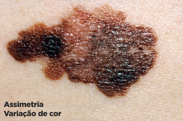 Assimetria e variação de cor: melanoma.