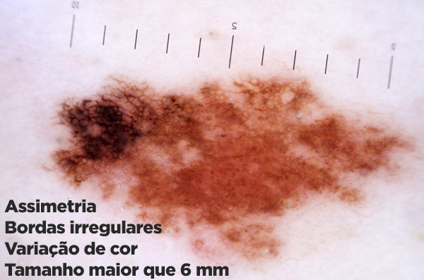 Assimetria, bordas irregulares, variação de cor, tamanho maior que 6 mm: melanoma.