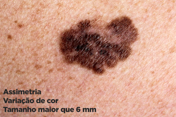 Assimetria, variação de cor e lesão maior que 6 mm: melanoma.