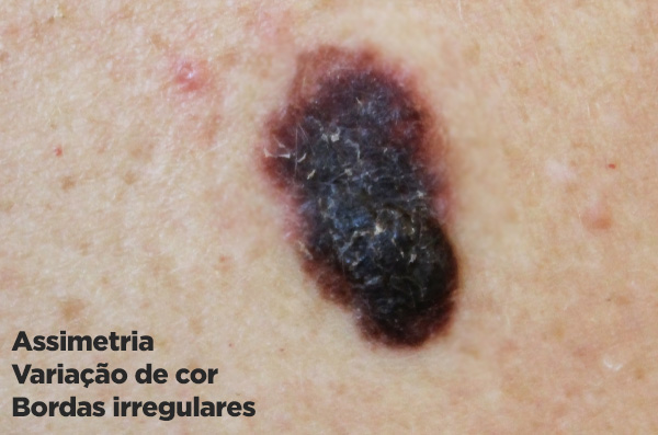Assimetria, variação de cor e bordas irregulares no melanoma.