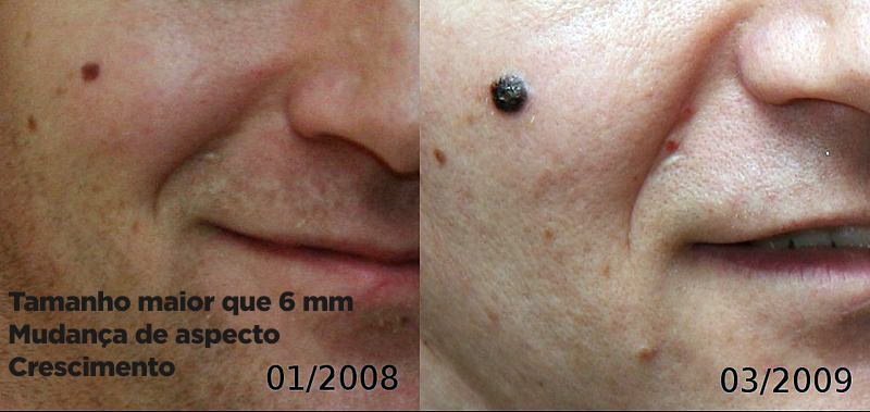 Lesão que muda de tamanho e de aspecto: melanoma