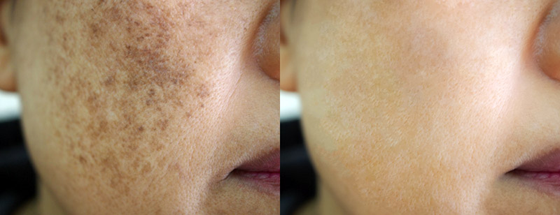 Melasma antes e depois do tratamento