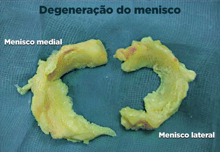 Meniscos com lesão degenerativa