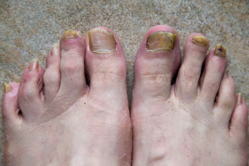 Onicomicose em ambos pés