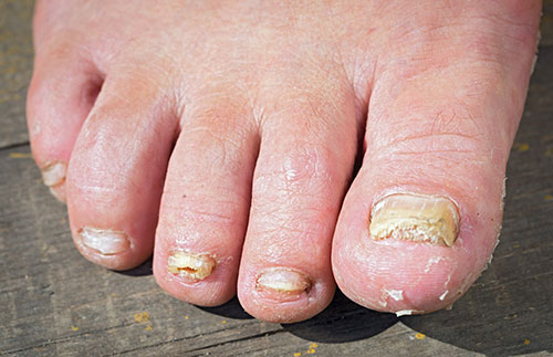Onicomicosis subungueal distal