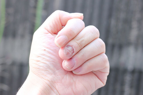 Onicomicosis subungueal proximal