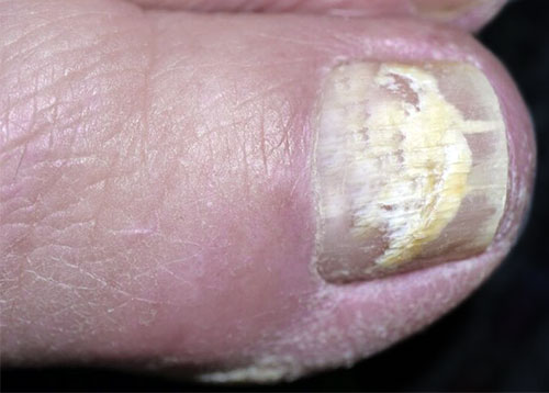 Onicomicosis superficial blanca