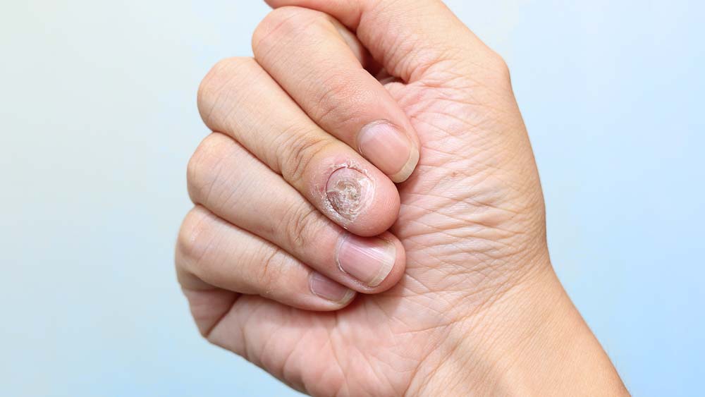Fotos de doenças das unhas