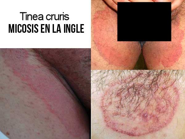 micose