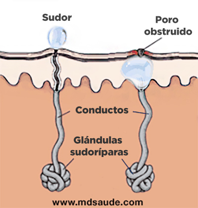 Poro de la piel bloqueado - Miliaria