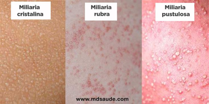 Tipos de miliaria