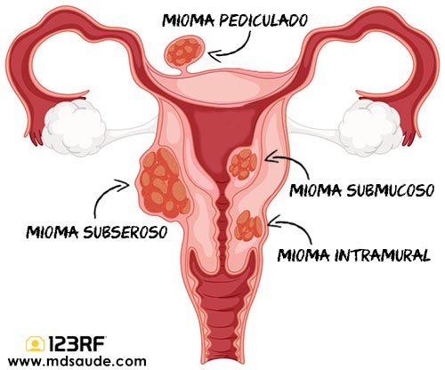 Tipos de mioma uterino