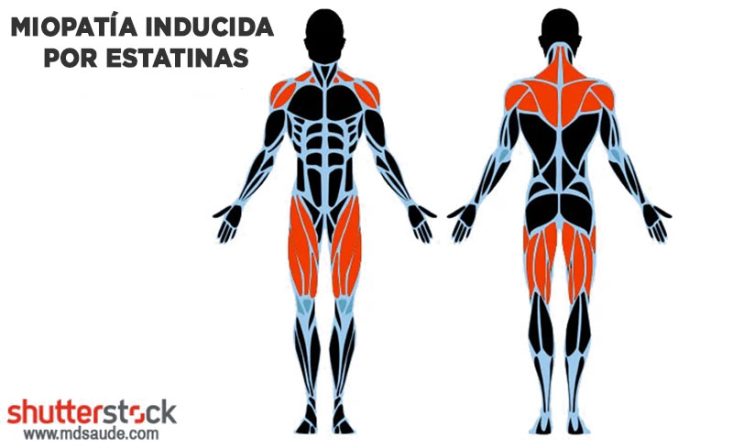 Miopatía inducida por estatinas
