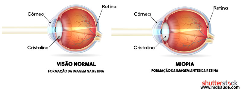Olho normal versus olho míope.
