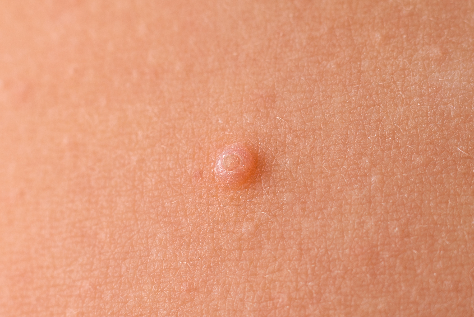 Lesão típica do molusco contagioso: pápulas em forma de cúpula com leve depressão central.