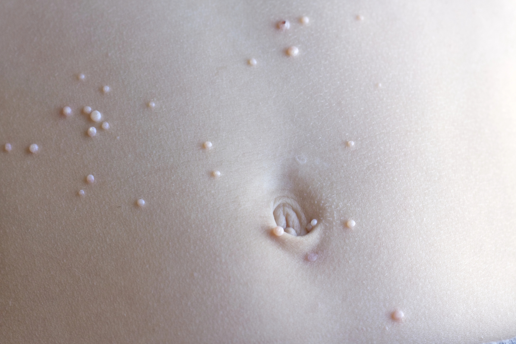 Multiplas pequenas lesões peroladas do molusco contagioso ao redor do umbigo