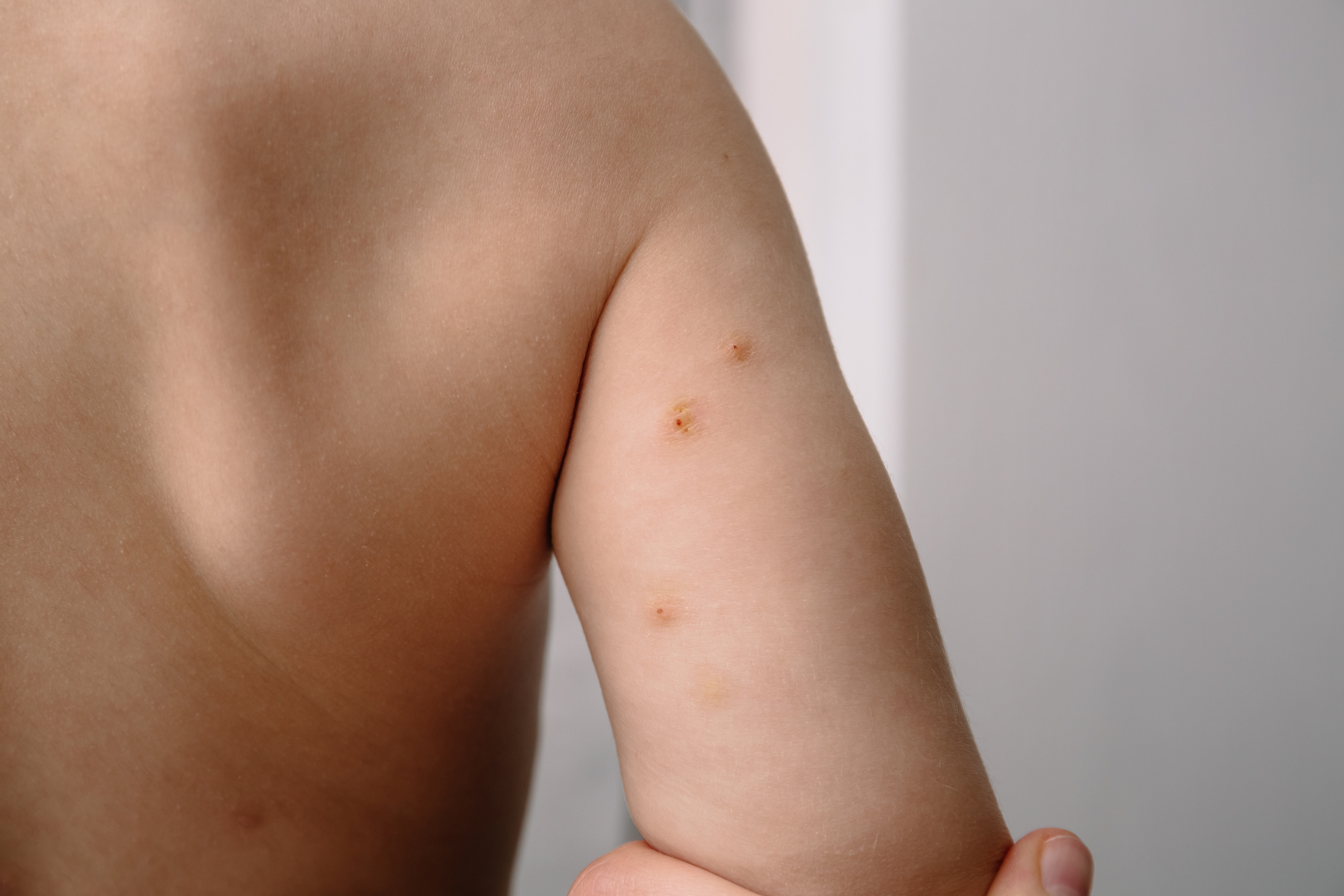 Lesões de molusco contagioso inflamadas pelo ato de coçar