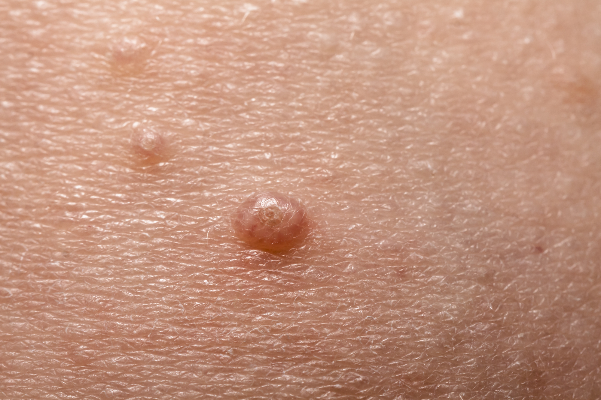 Pápula do molusco contagioso