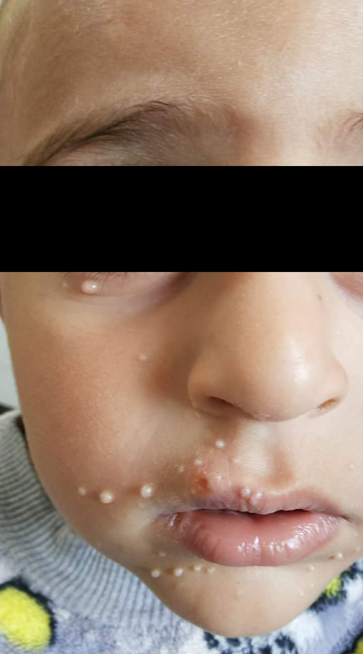 Molusco contagioso no rosto de uma criança