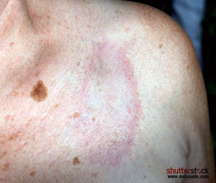 Esclerodermia localizada: morfeia