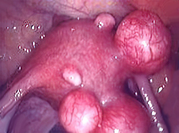 Múltiplos miomas