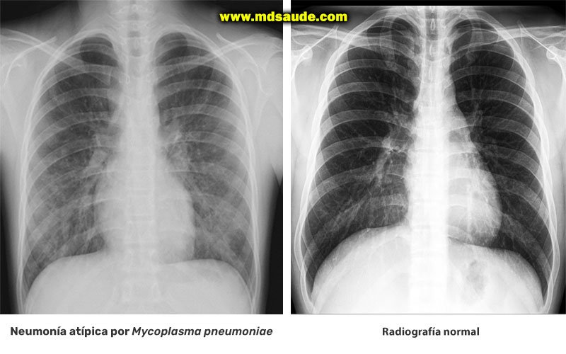 Infiltrados intersticiales en un paciente con neumonía atípica por Mycoplasma pneumoniae.